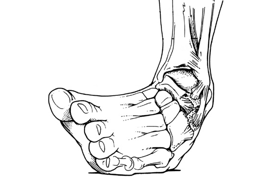 sprained-ankle